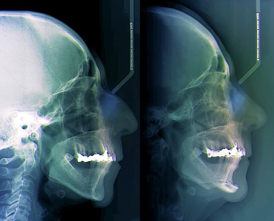 Facial Plastic Surgery Photograph by Zephyr/science Photo Library