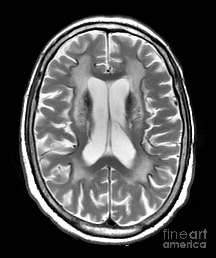 Mri Brain Photograph - Fahrs Syndrome, Mri by Living Art Enterprises