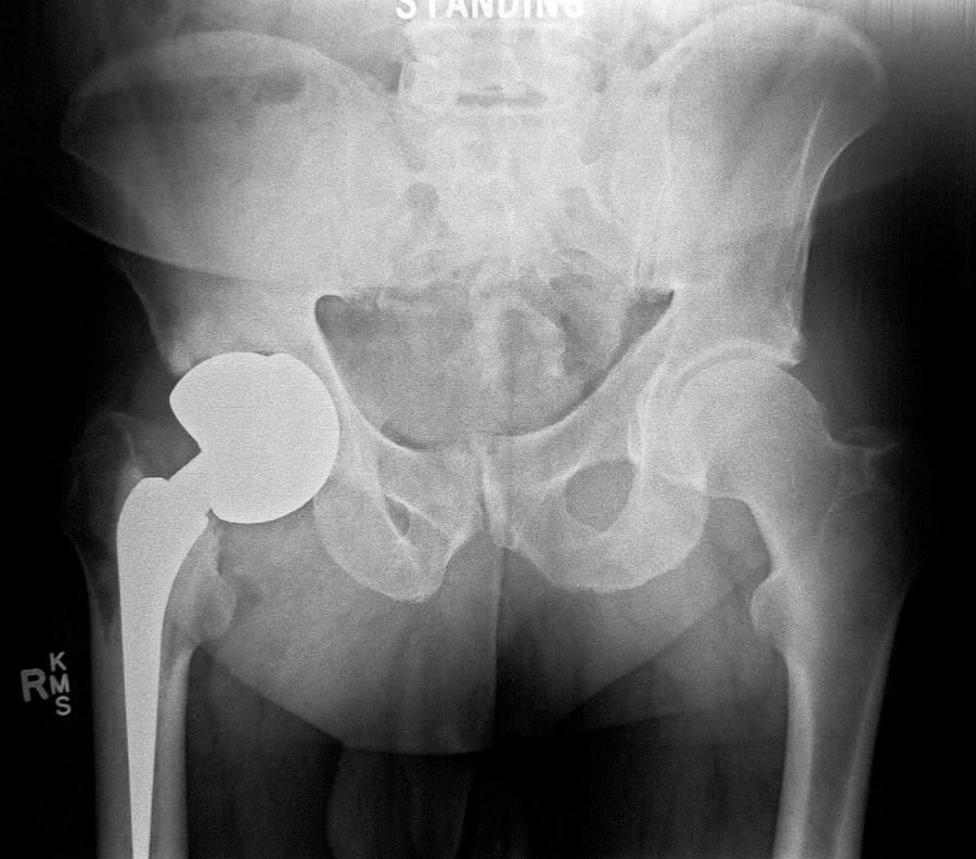 Failed Hip Replacement Photograph By Antonia Reevescience Photo