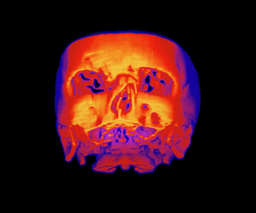 False-colour 3-d Ct Scan Of Broken Nasal Bone Photograph by Science Photo Library