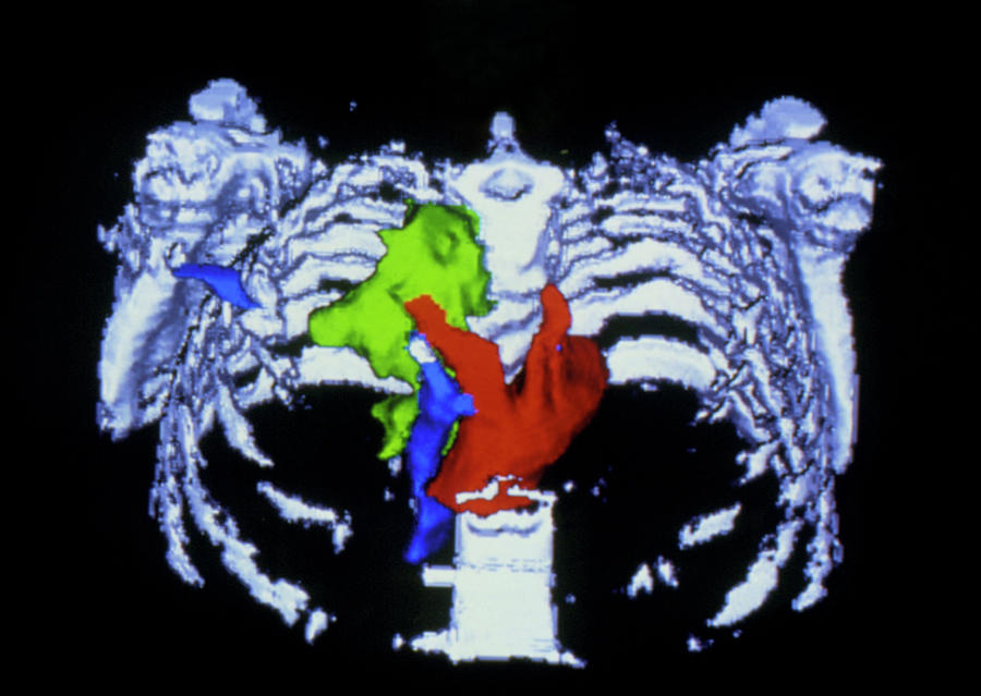 False-colour 3-d Ct Scan Of Pancreatic Cancer Photograph by Cnri/science Photo Library