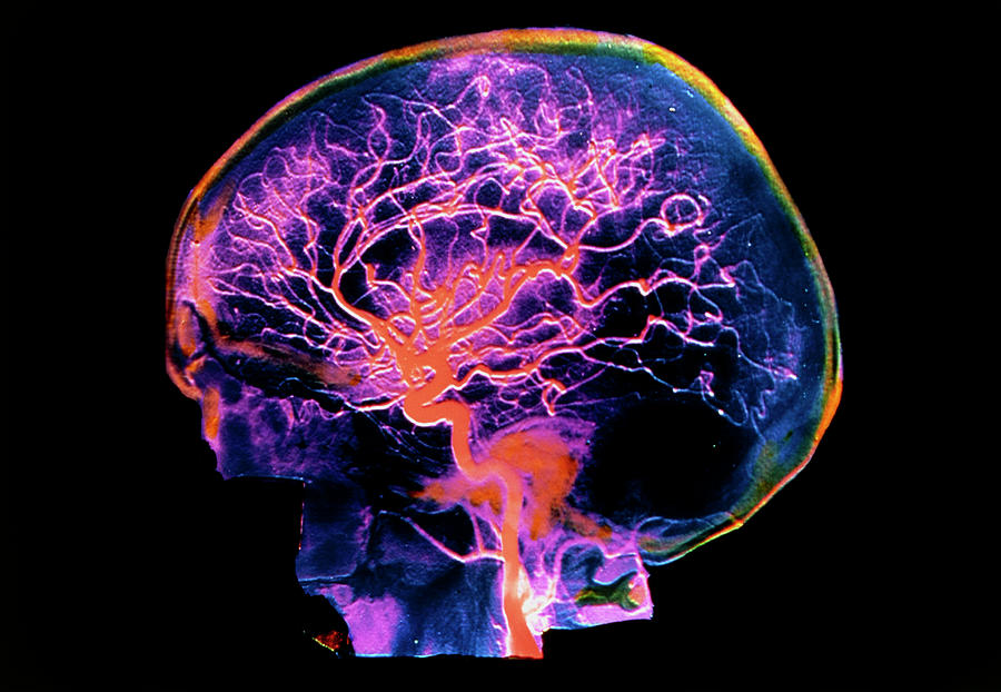 False-colour Arteriograph Of The Human Head Photograph by Alain Pol, Ism/science Photo Library