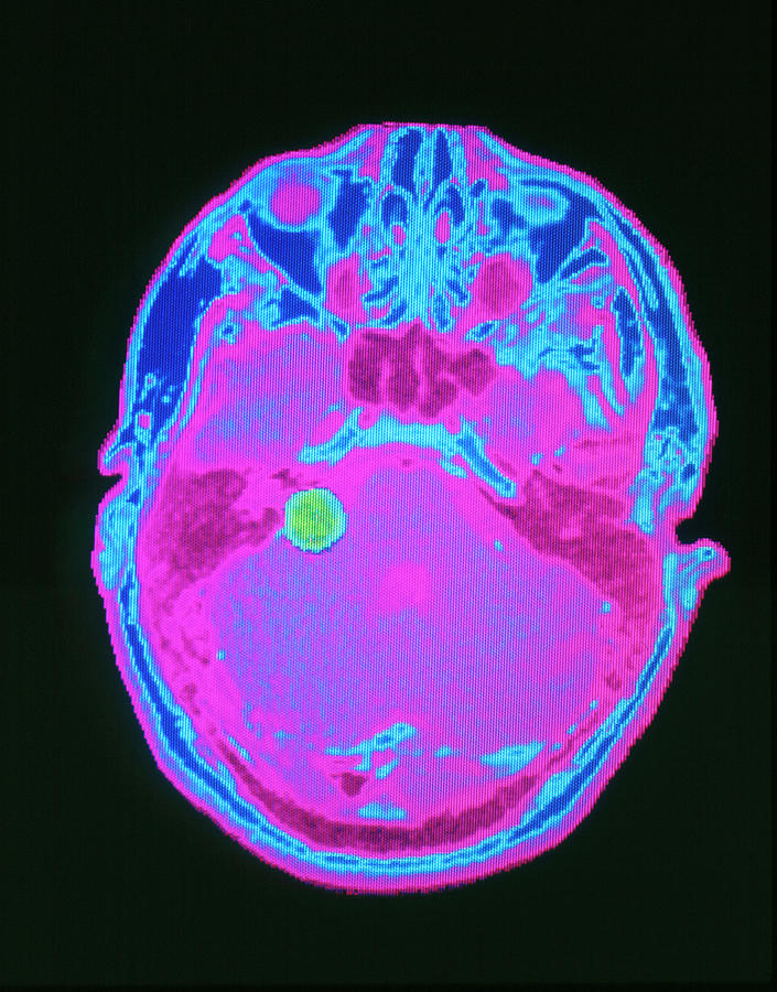 False-colour Axial Mri Scan: Acoustic Neuroma Photograph by Mehau Kulyk/science Photo Library
