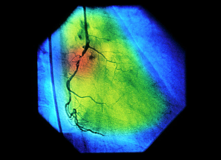 False-colour Coronary Angiogram: Stenosis Photograph by Mehau Kulyk/science Photo Library