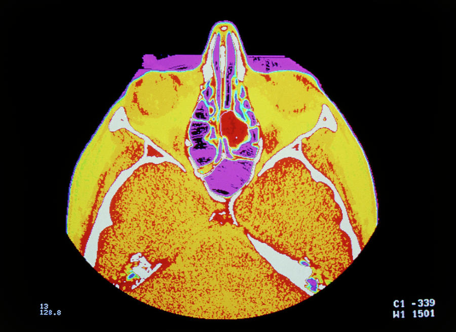 Ct Scan Photograph - False-colour Ct Scan Of A Head Showing Nasal Polyp by Cnri/science Photo Library