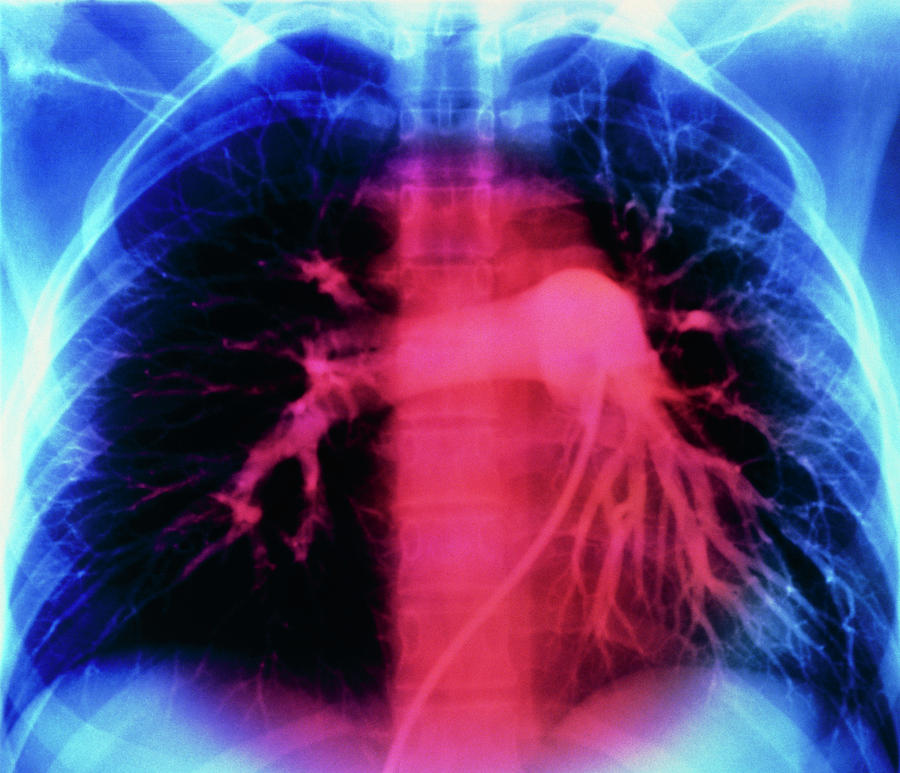 False-colour Normal Pulmonary Arteriogram Photograph by Mehau Kulyk/science Photo Library