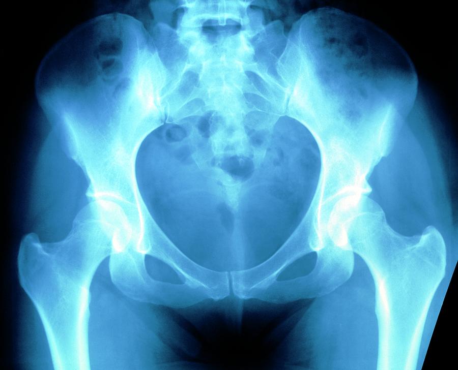 normal hip xray labeled