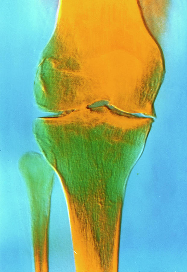 False-colour X-ray Of An Arthritic Knee Joint Photograph by Alain Pol ...