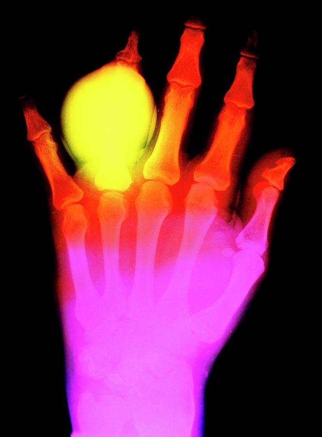 False-colour X-ray Of Hand In Gouty Arthritis Photograph by Science Photo Library
