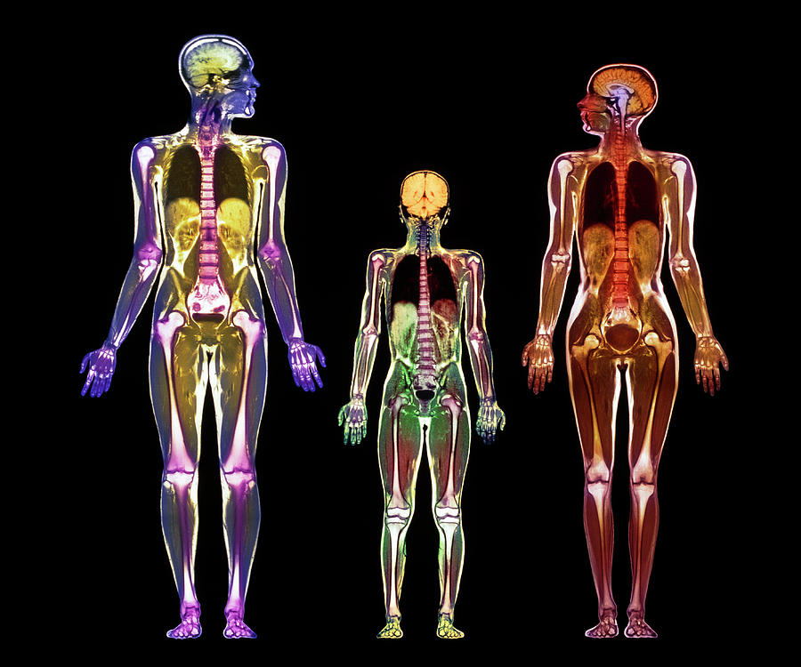 Skeleton Photograph - Family Mri Scans by Simon Fraser/science Photo Library