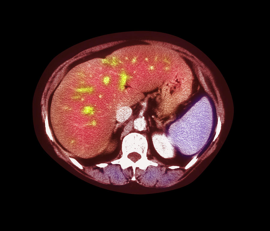 Fatty Liver Ct Scan Photograph by Simon Fraser/freeman Hospital ...