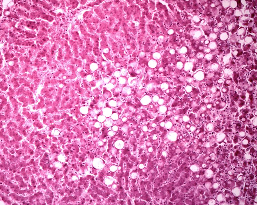 Fatty Liver Photograph by Jose Calvo / Science Photo Library