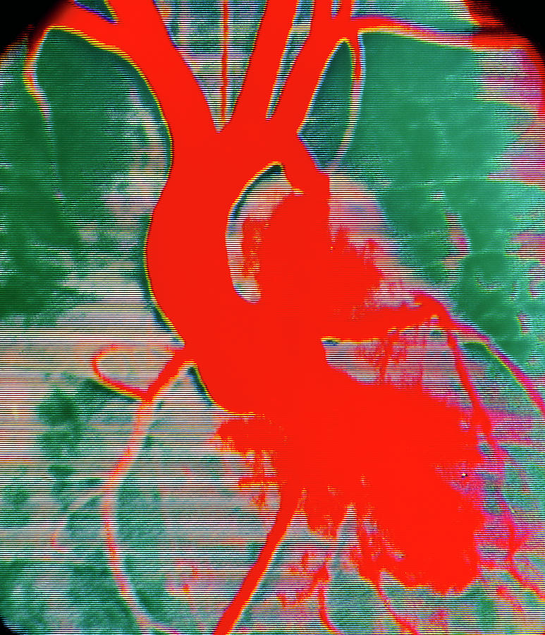 Angiography Photograph - F/col Angiogram Of Ductus Arteriosis In Child by Cardio-thoracic Centre/freeman Hospital, Newcastle-upon-tyne/science Photo Library Angiography Photograph - F/col Angiogram Of Ductus Arteriosis In Child by Cardio-thoracic Centre/freeman Hospital, Newcastle-upon-tyne/science Photo Library