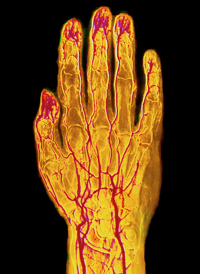 F/col Arteriogram Of Human Hand Photograph by Alain Pol, Ism/science Photo Library