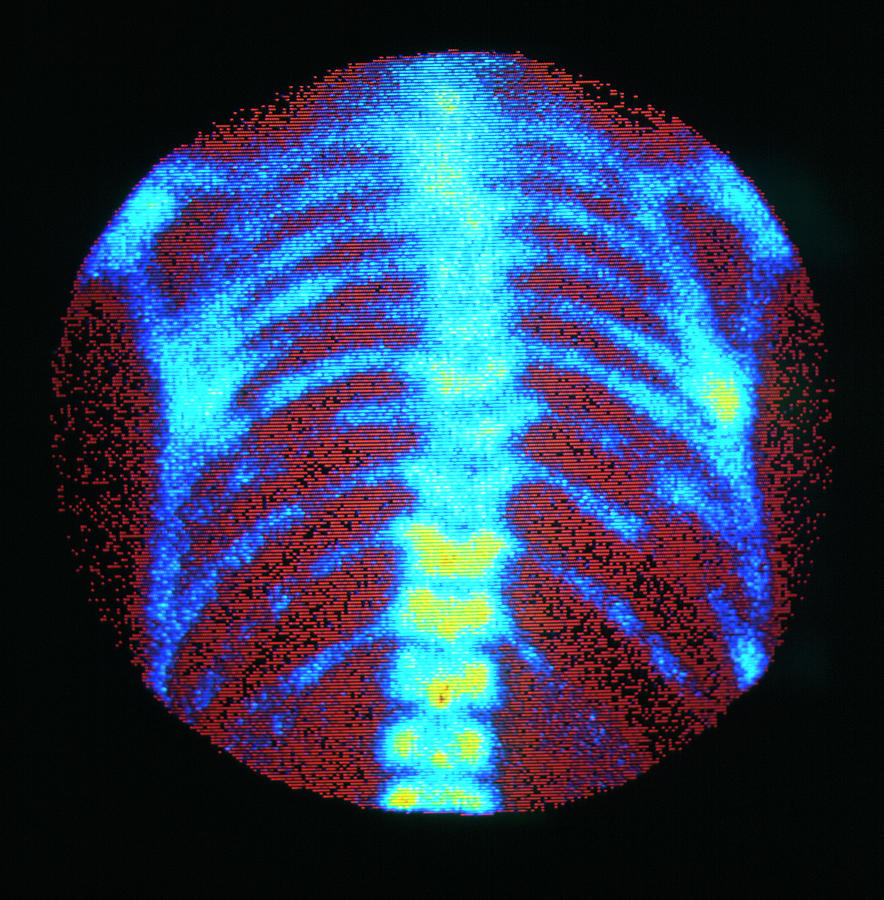 F/col Gamma Bone Scan Showing Secondary Cancer Photograph By Simon ...