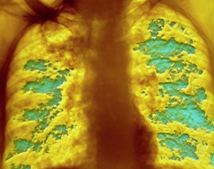 F/col X-ray Of Silicosis Photograph by Alain Pol, Ism/science Photo ...