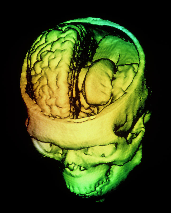 F/colour 3-d Ct Scan Of Human Brain Within Skull Photograph by Gjlp/science Photo Library