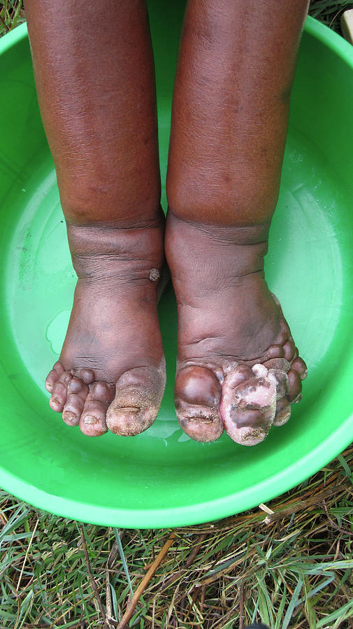 Feet In Podoconiosis Photograph by Fasil Ayele, National Institutes Of Health /science Photo Library