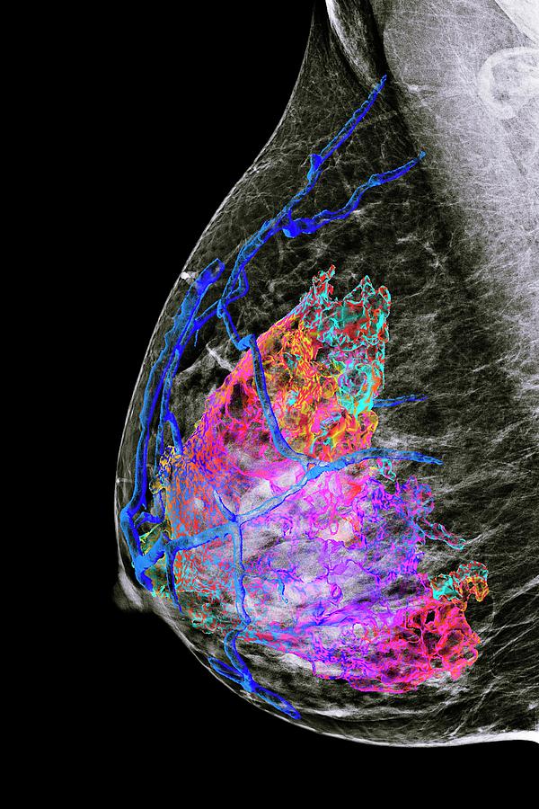 Female Breast Photograph by K H Fung/science Photo Library