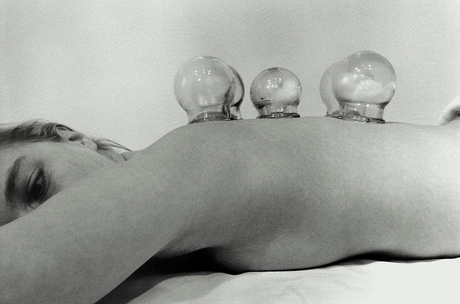 Female Patients Back Receiving Cupping Treatment Photograph by Horacio Sormani/science Photo Library