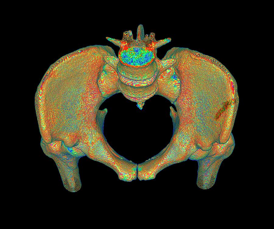 Skeleton Photograph - Female Pelvis by K H Fung/science Photo Library