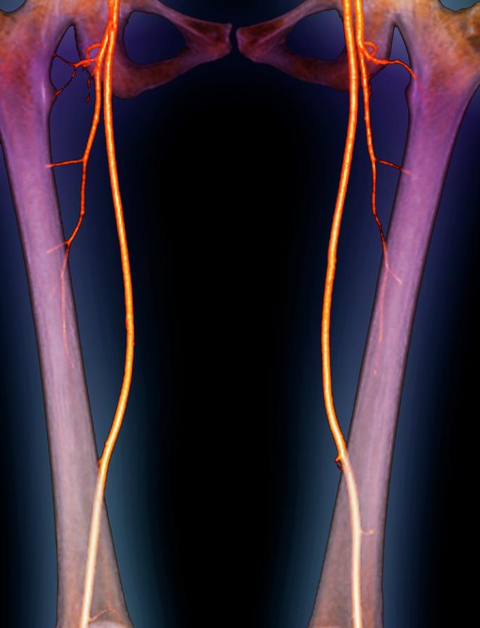 Femoral Arteries Photograph By Zephyrscience Photo Library Fine Art America 5056