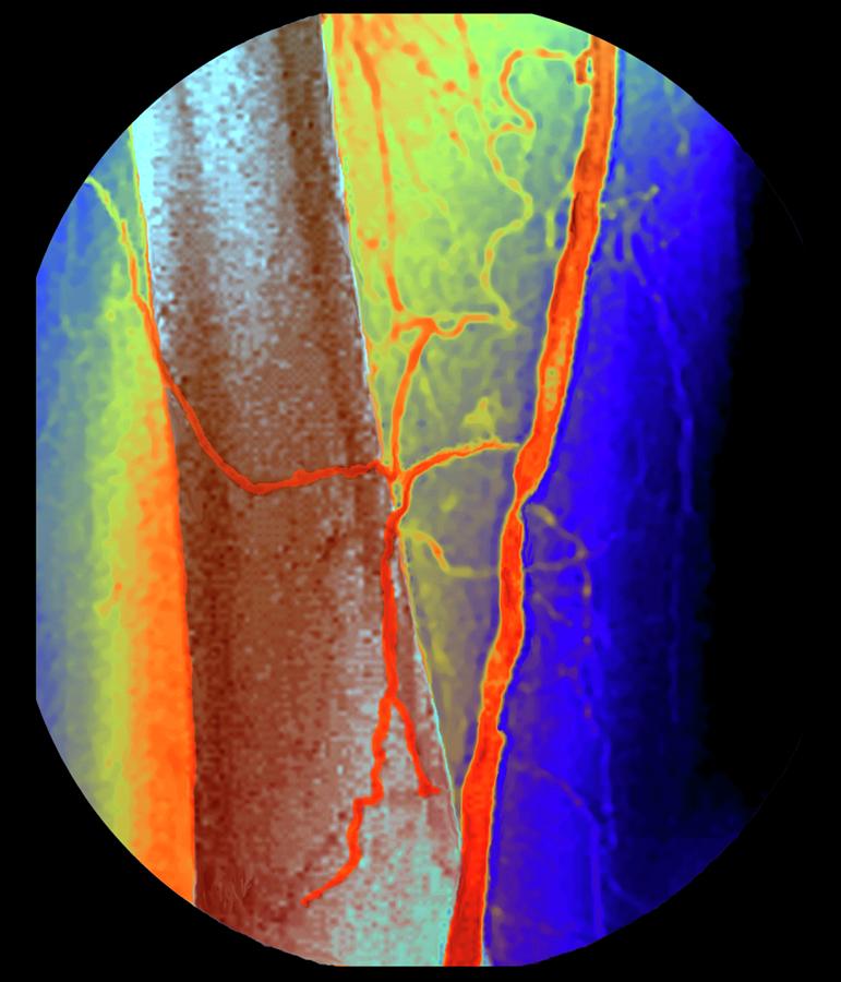 Femoral Artery Narrowing Photograph by Zephyr/science Photo Library ...