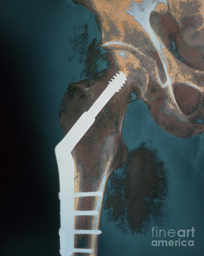 Femur Implant Photograph by Bill Longcore