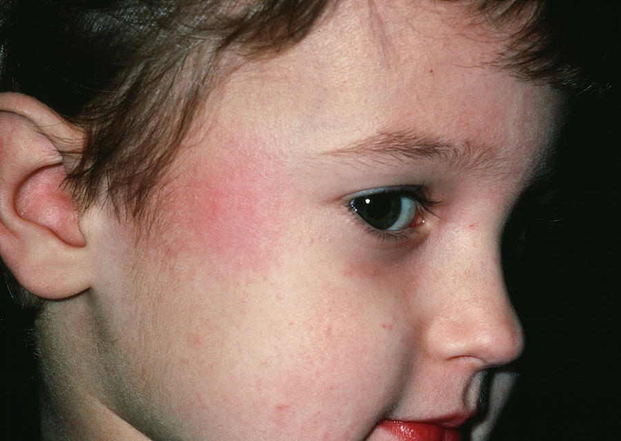 Fifth Disease Slapped Cheek Mark On Boy Photograph by Dr P. Marazzi