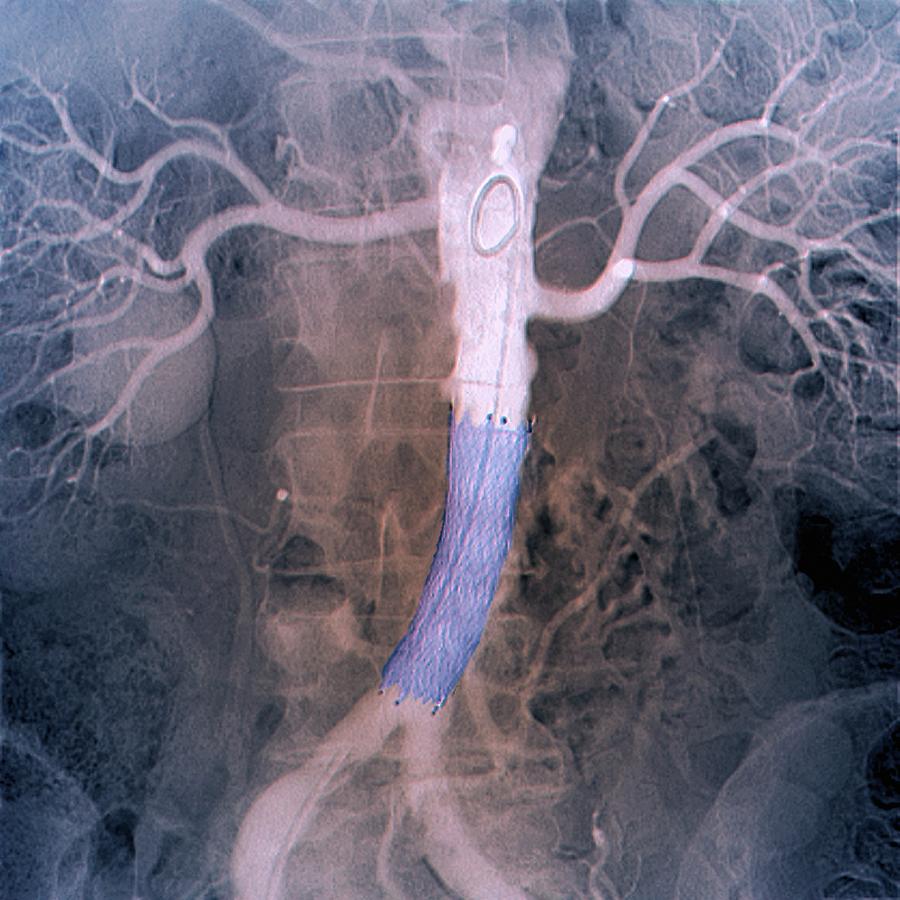 Final Position Of Stent In Aorta Photograph By Zephyrscience Photo Library 3074