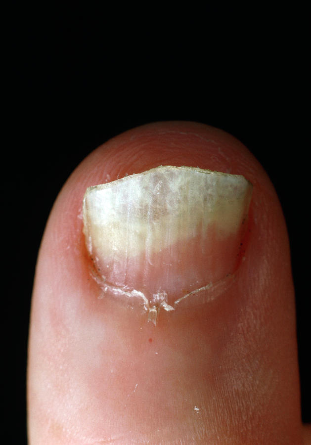 Fingernail Infected With Ringworm Photograph By Dr Jeremy Burgess