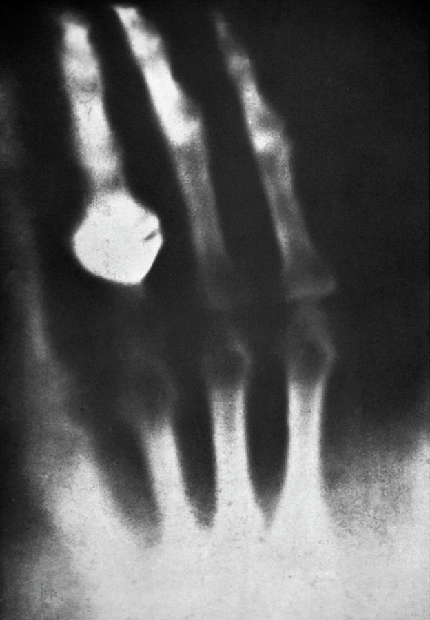 First Ever Human X-ray Photograph by Science Photo Library - Pixels Merch