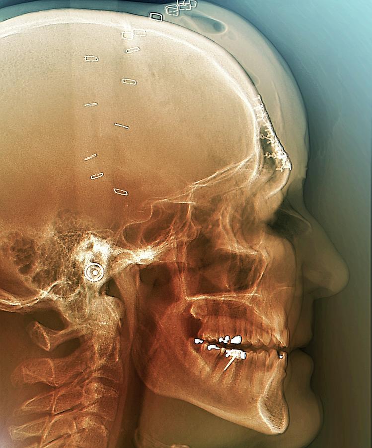 Fixed Skull Fractures After Road Accident Photograph By Zephyrscience Photo Library Pixels 0040