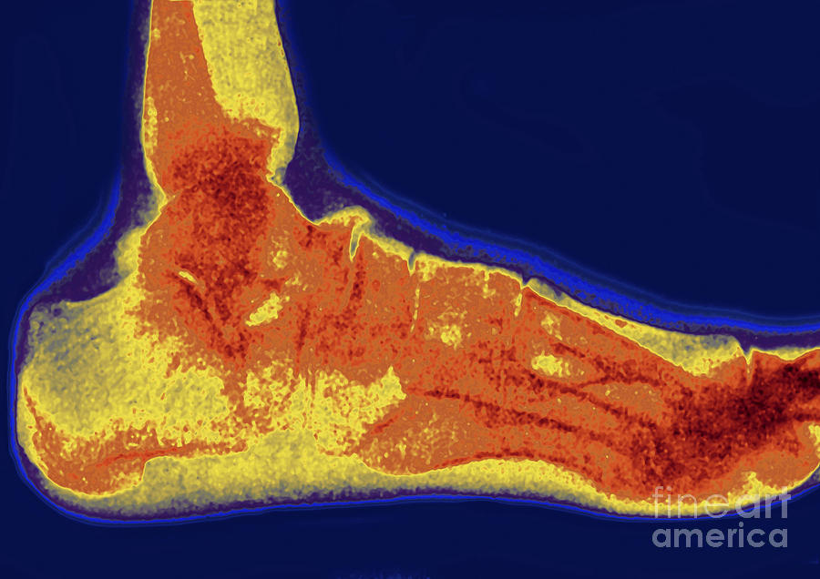 Flat Foot X-Ray Photograph by Bsip - Fine Art America