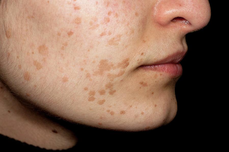 flat-warts-on-the-face-photograph-by-dr-harout-tanielian-science-photo