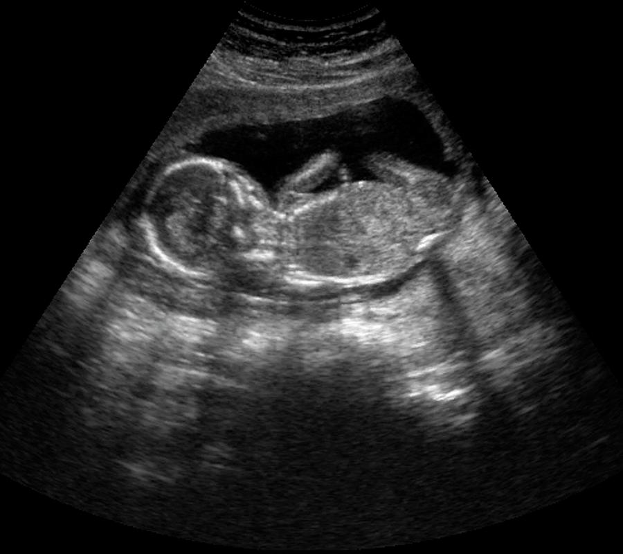 Пол ребенка фото на 14 неделе беременности фото