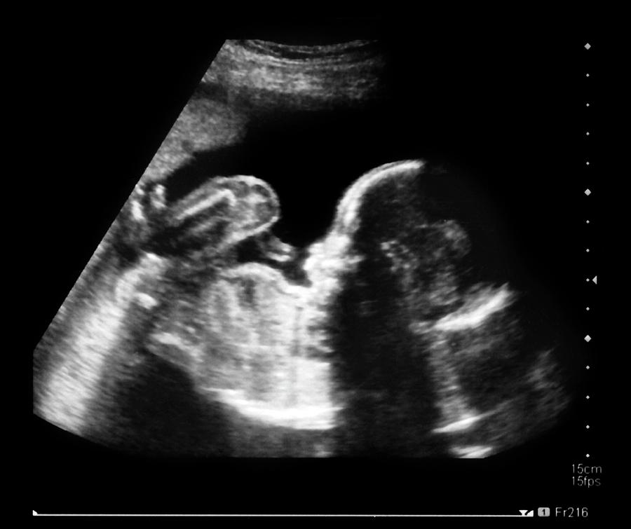 Фото узи беременности 20 недель мальчик