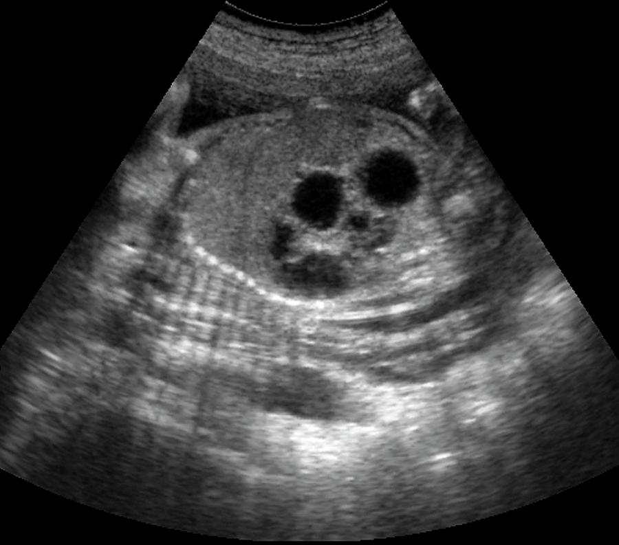 Duodenal Atresia