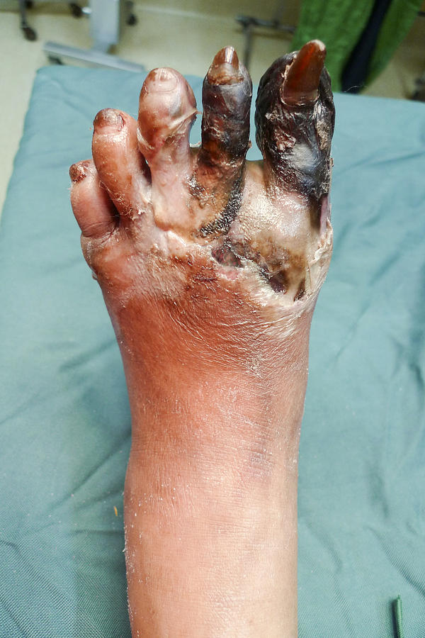 Foot gangrene Photograph by Karl Tapales