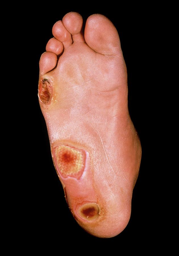 Foot Ulcers In Diabetes Photograph by St Bartholomew Hospital/science Photo Library