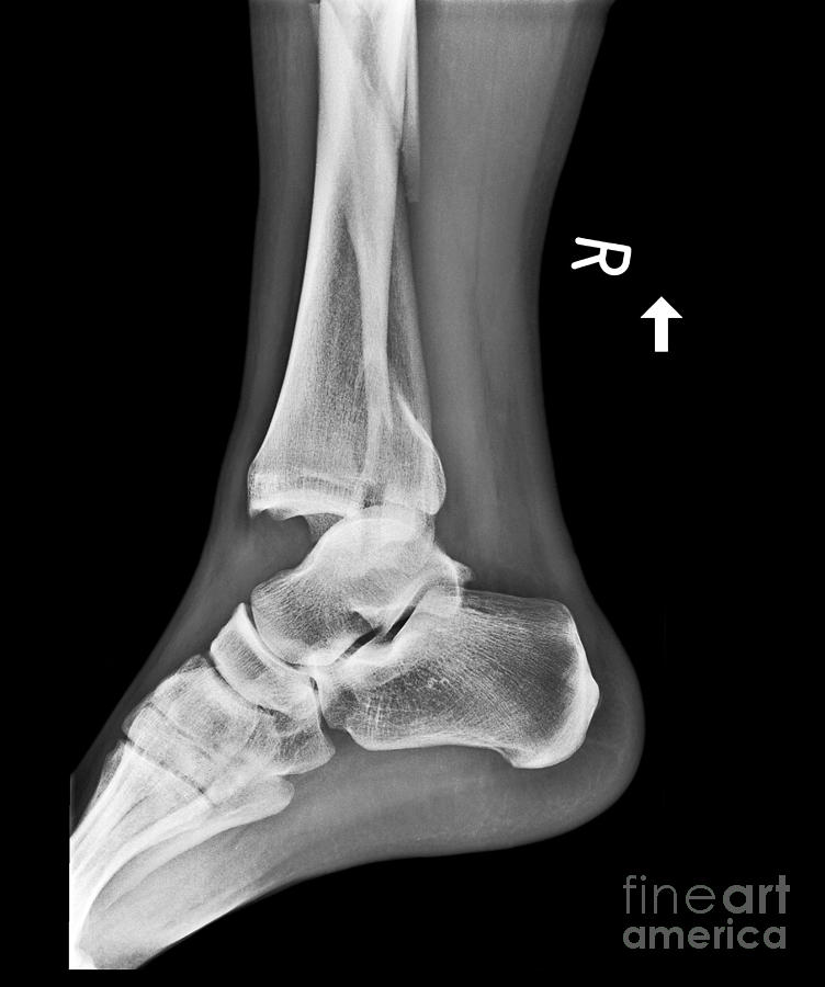 Fracture Photograph - Fractured And Dislocated Ankle, X-ray by Science Photo Library
