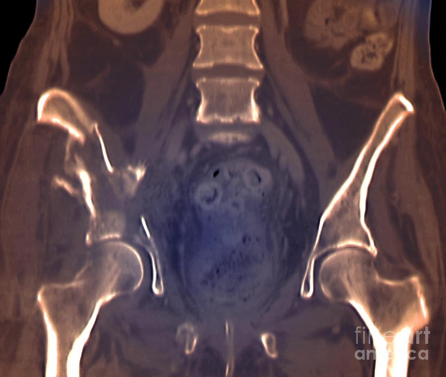 Fractured Pelvis Ct Scan Photograph By Zephyr Pixels 1755