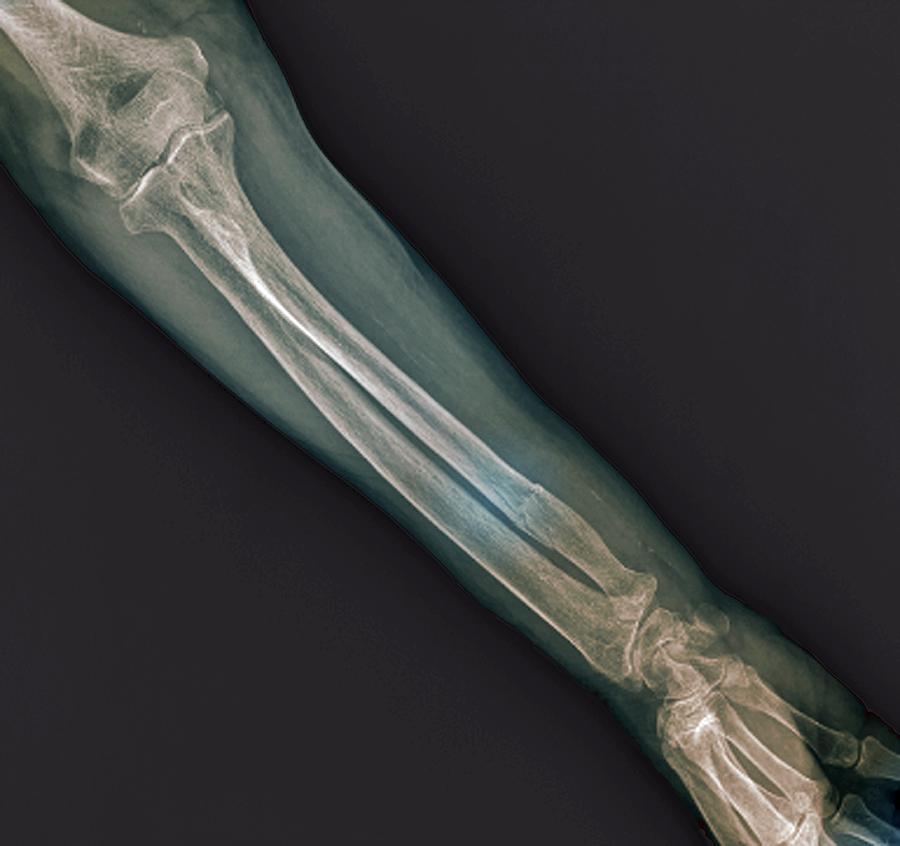 Fractured Ulna Arm Bone Photograph By Zephyrscience Photo Library