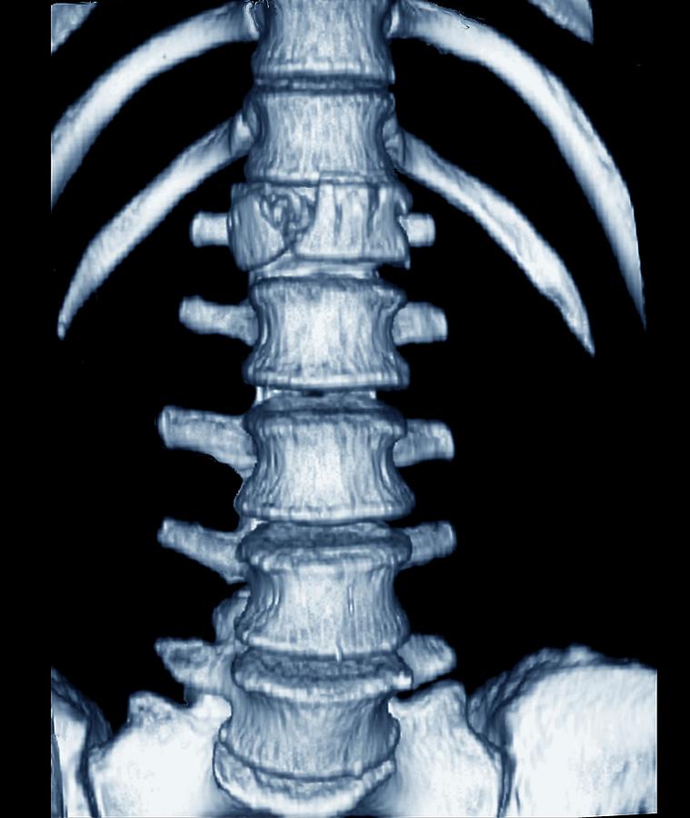 Fractured Vertebra by Zephyr/science Photo Library