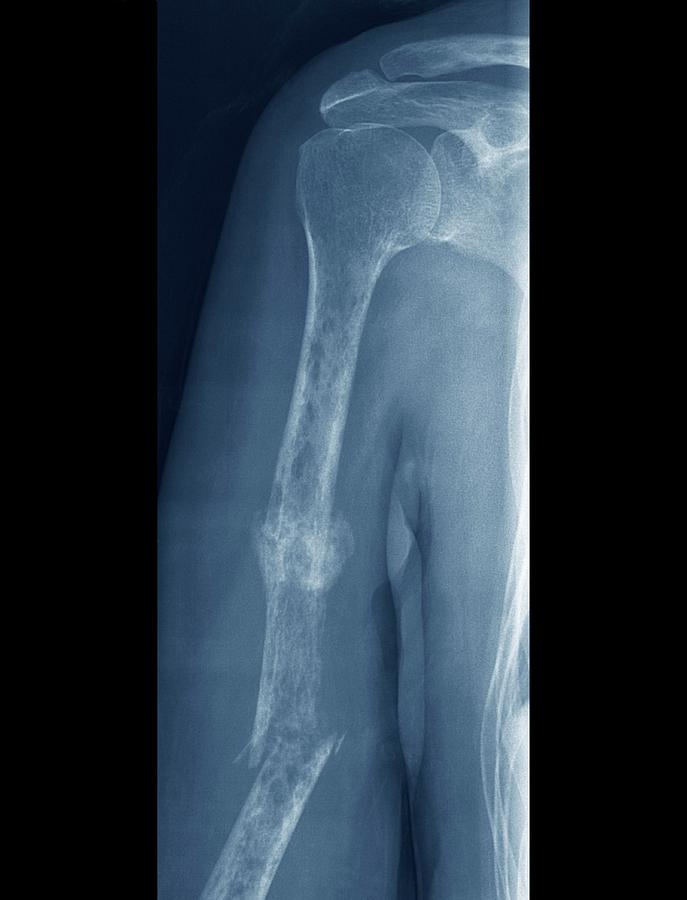 Fractures And Bone Cancer Photograph by Zephyr/science Photo Library