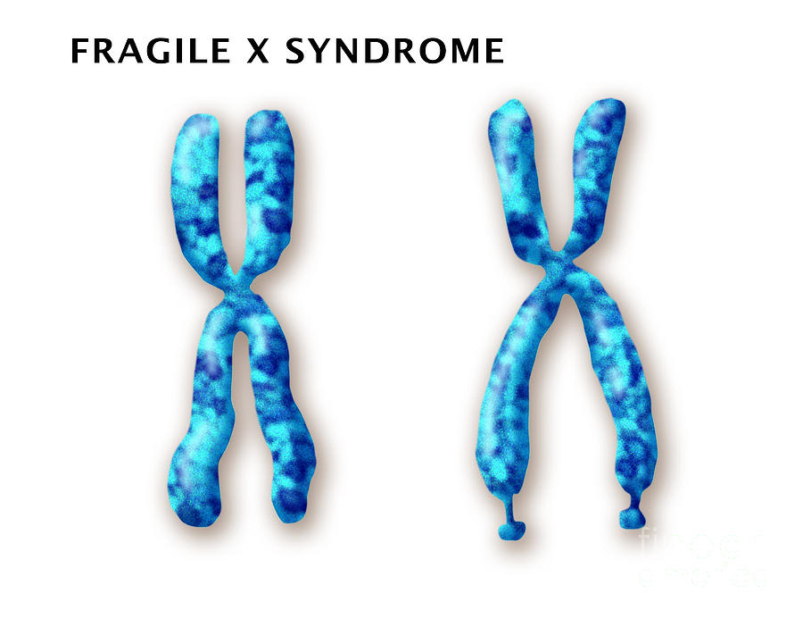 Fragile X Syndrome Photograph By Monica Schroeder 