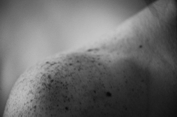 Black And White Photograph - Freckle Cancer by Jessica Sherlock
