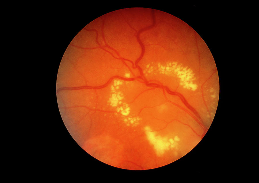 Ангиопатия сосудов сетчатки что это. Диабетическая ретинопатия сетчатки. Диабетическая микроангиопатия ретинопатия. Диабетическая ангиопатия сетчатки глаза. Пролиферативная ретинопатия.