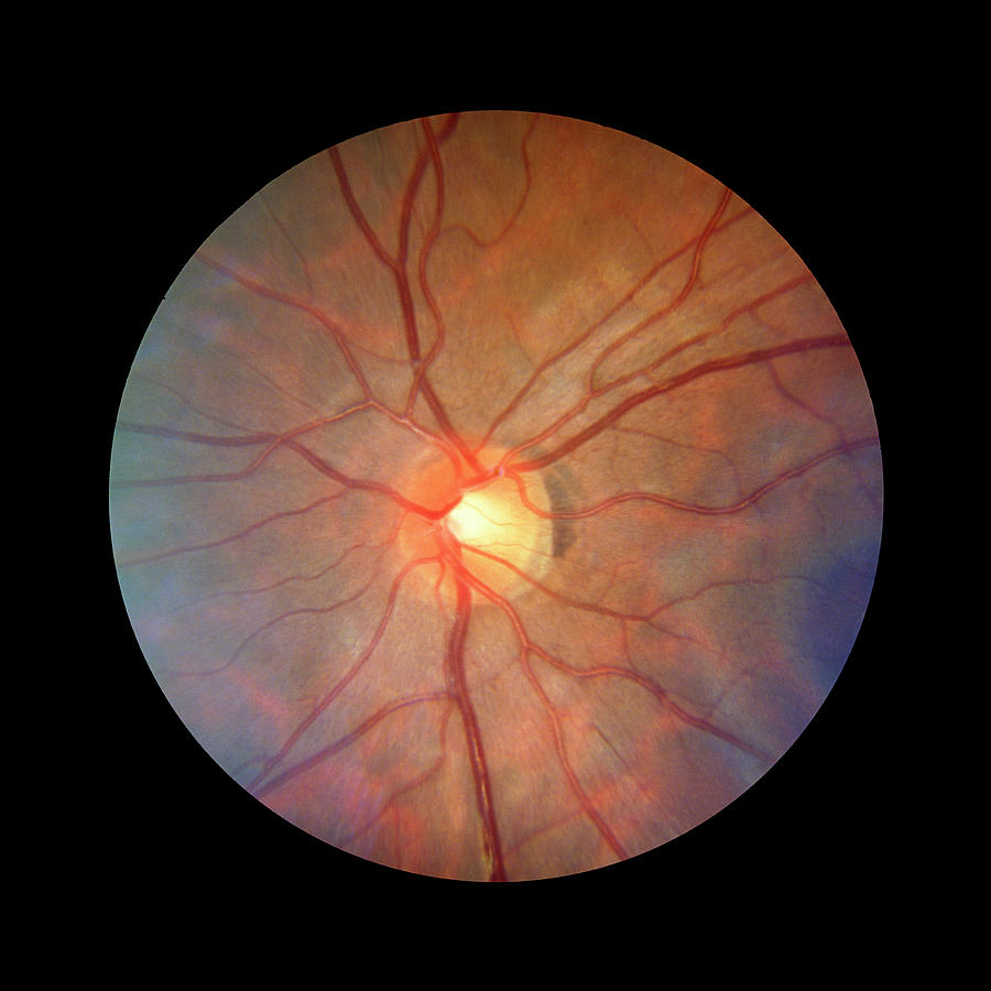 Fundus Camera Image Of A Normal Retina Photograph by Rory Mcclenaghan/science Photo Library