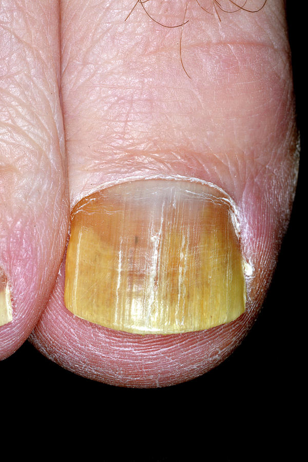 Fungal Nail Infection After Treatment Photograph by Dr P. Marazzi ...